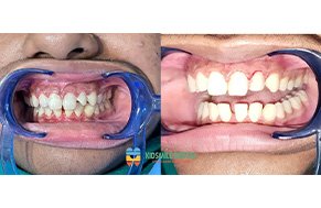 Transforming Smiles: A Journey to Healthy Gums and Tooth Restoration