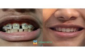 Smile Story: A Journey from Self-Conscious to Confident