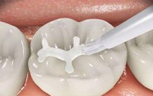 Fluoride & Sealants