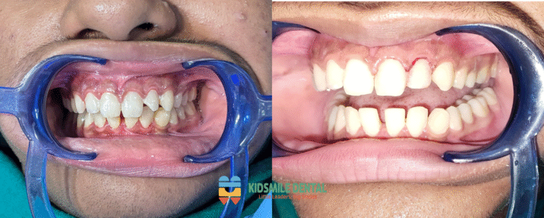 Transforming Smiles: A Journey to Healthy Gums and Tooth Restoration